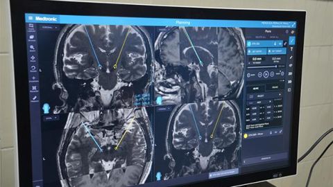 Hábitos neuroprotectores y detección oportuna del Parkinson mejora la calidad de vida de pacientes